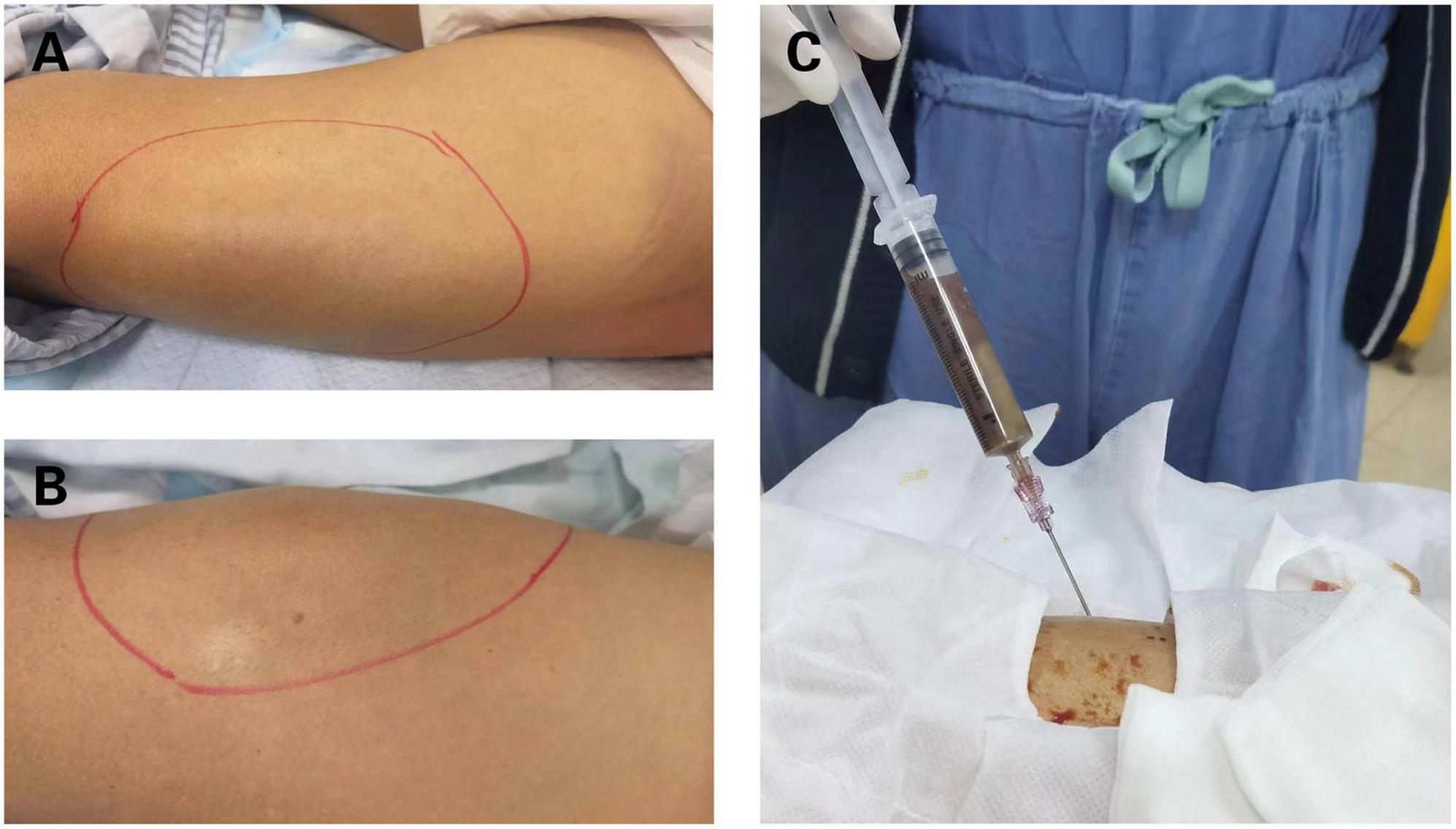 Case report:Multiple abscesses caused by Porphyromonas gingivalis diagnosed by metagenomic next-generation sequencing